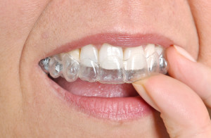 You're never too old for Invisible braces.